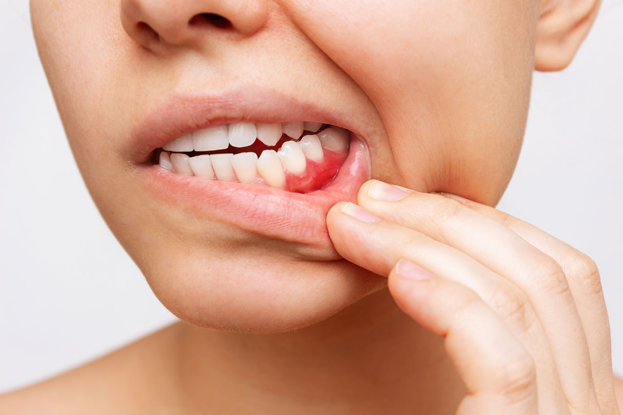 Gum Disease Treatment: How to Protect Your Gums Before Small Problems Become Big Ones