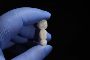 Dental Bridges: A Practical Way to Replace Missing Teeth and Restore Your Bite