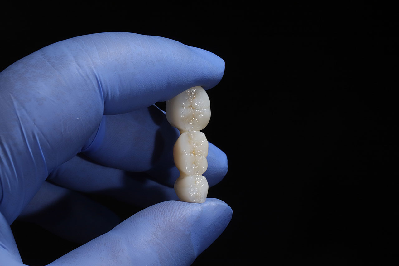Dental Bridges: A Practical Way to Replace Missing Teeth and Restore Your Bite